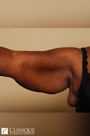Liposuction before and after - before