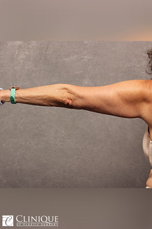 Liposuction before and after - before