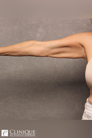 Liposuction before and after - before