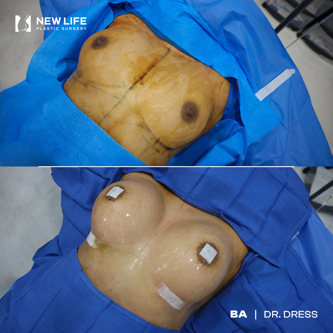 Breast Augmentation before and after - after