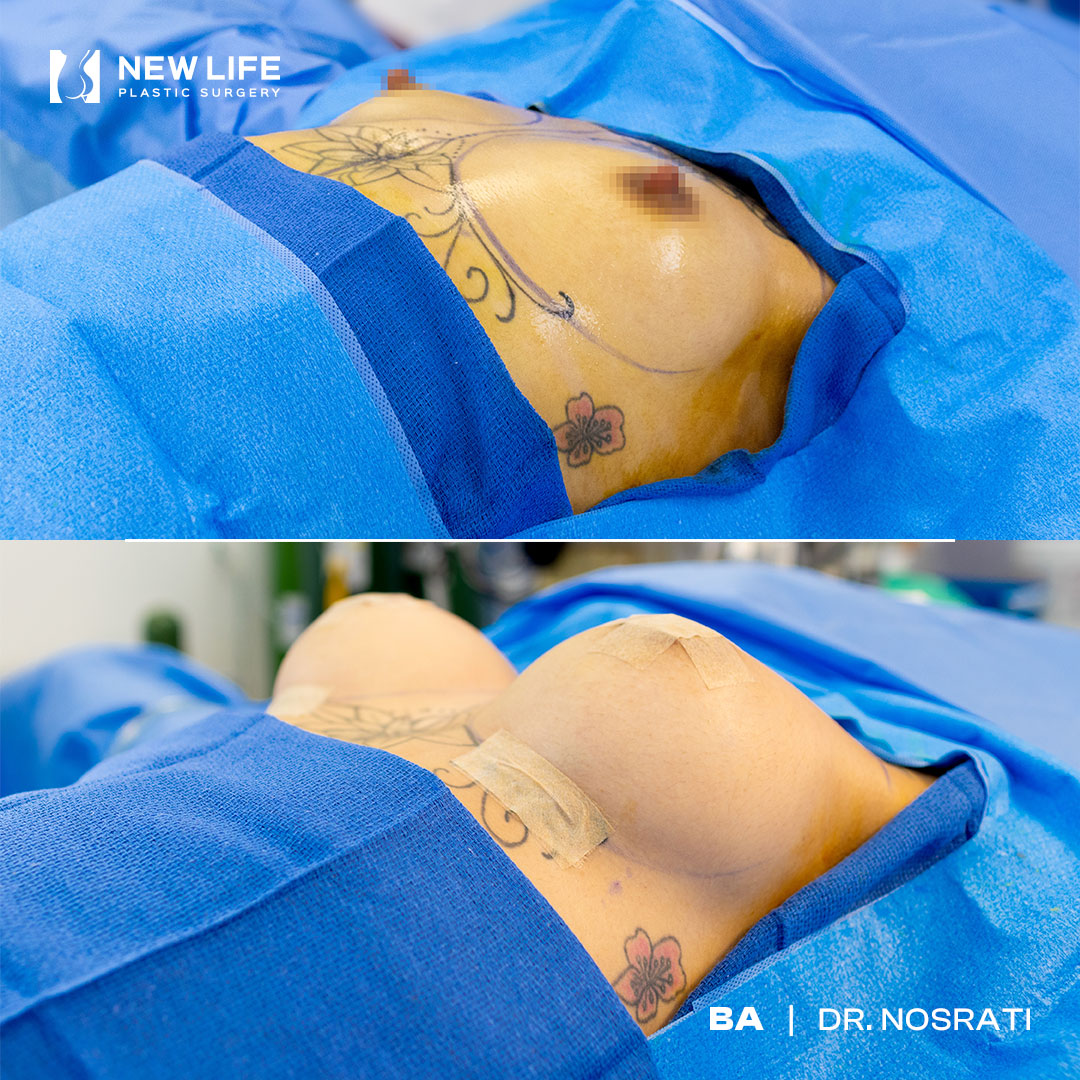 Breast Augmentation before and after - after