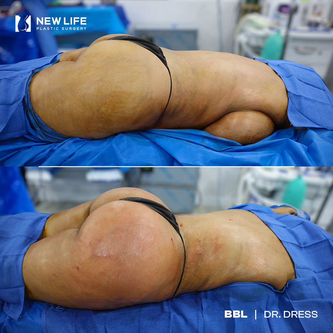BBL before and after - after