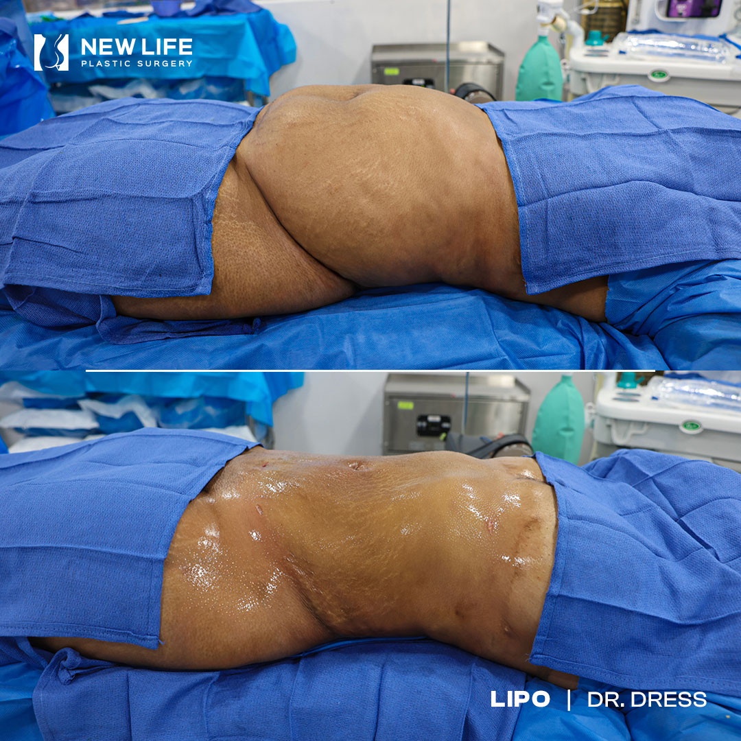 Liposuction before and after - after
