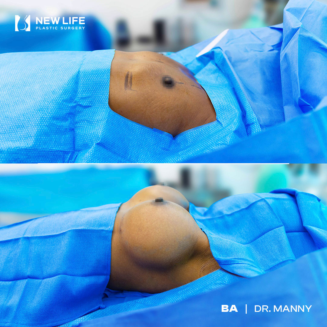 Breast Augmentation before and after - after