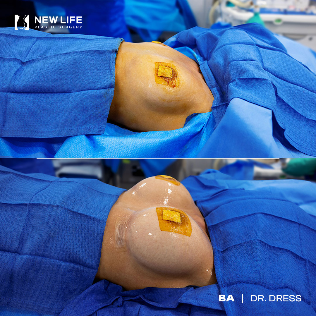 Breast Augmentation before and after - after