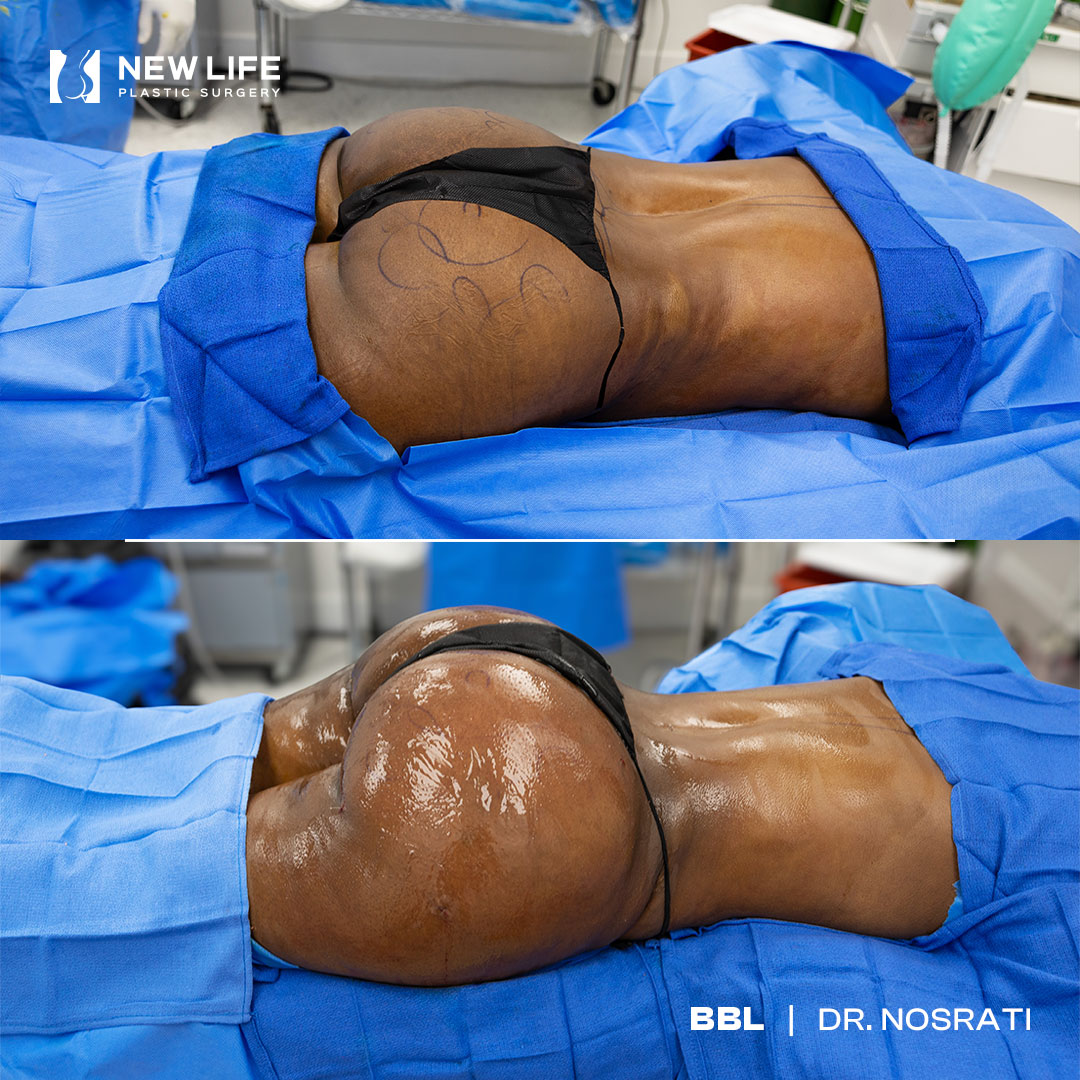 BBL before and after - after