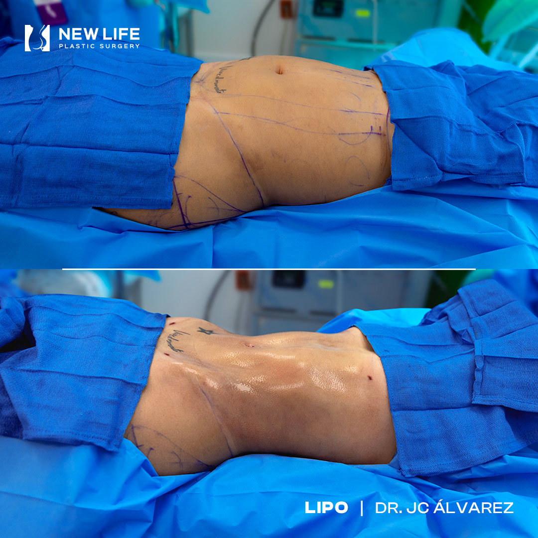 Liposuction before and after - after