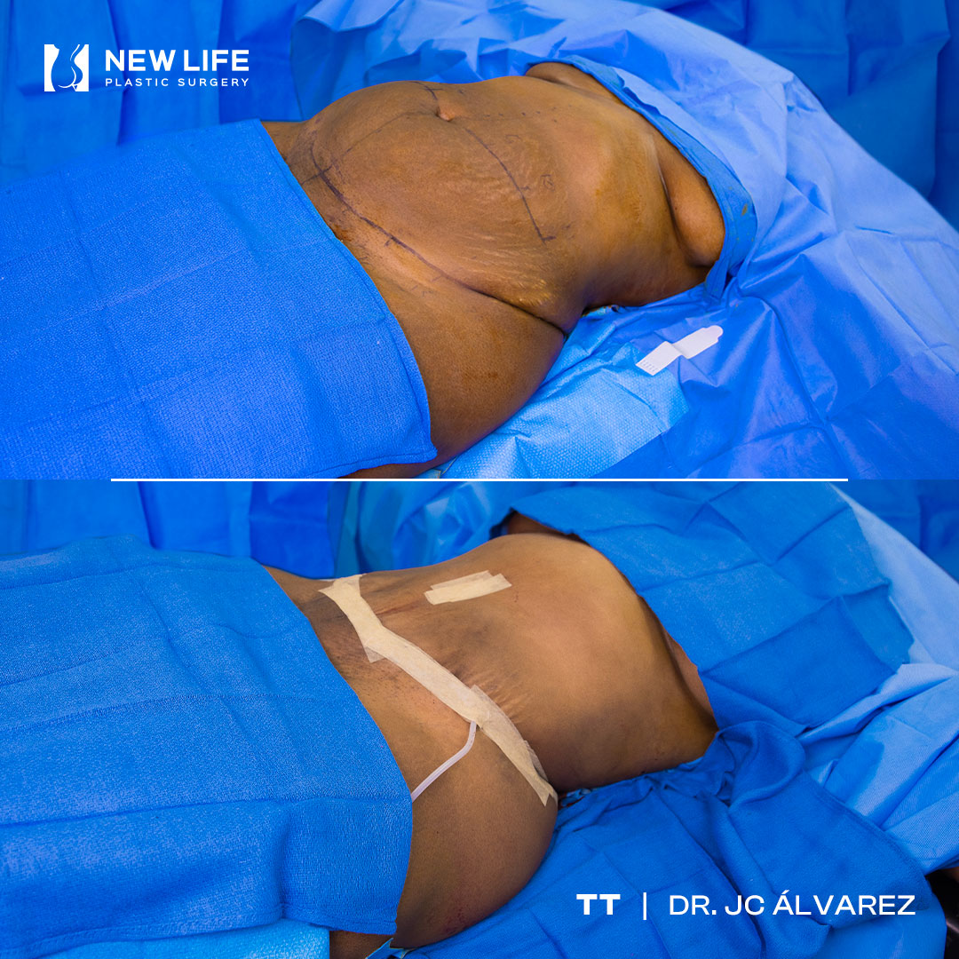 Tummy Tuck before and after - after
