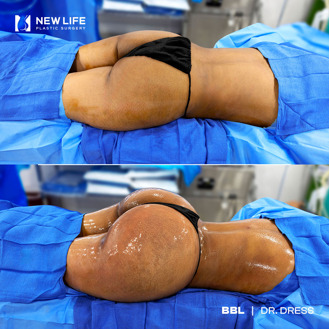 BBL before and after - after