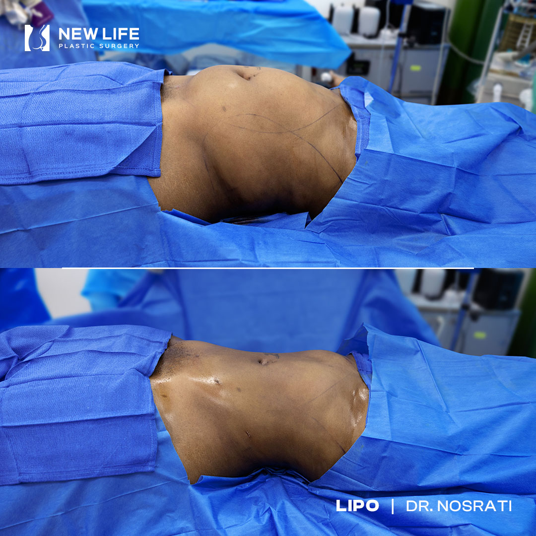 Liposuction before and after - after
