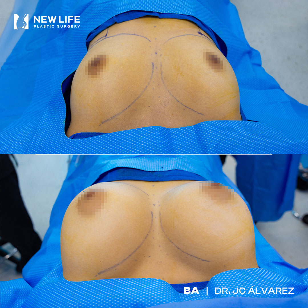 Breast Augmentation before and after - after
