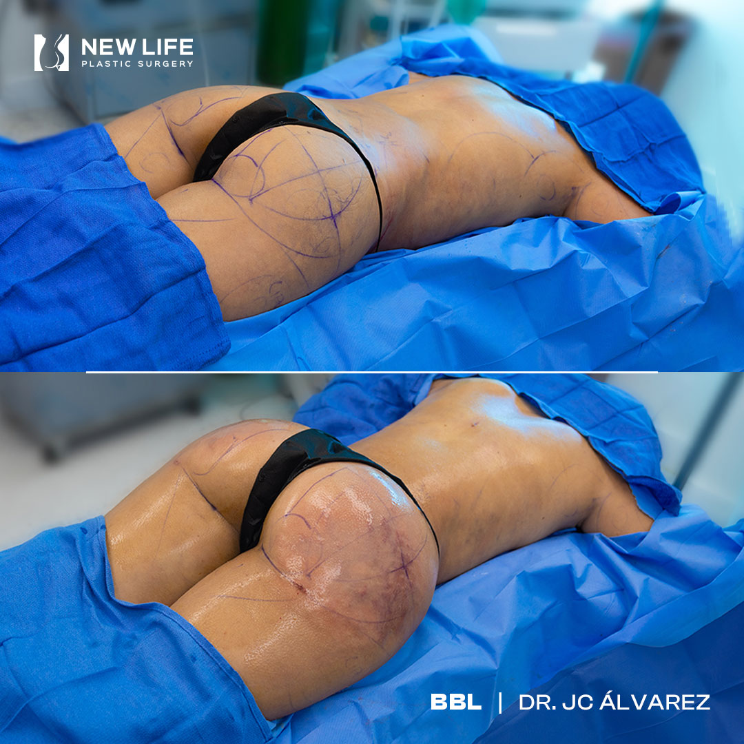 BBL before and after - before
