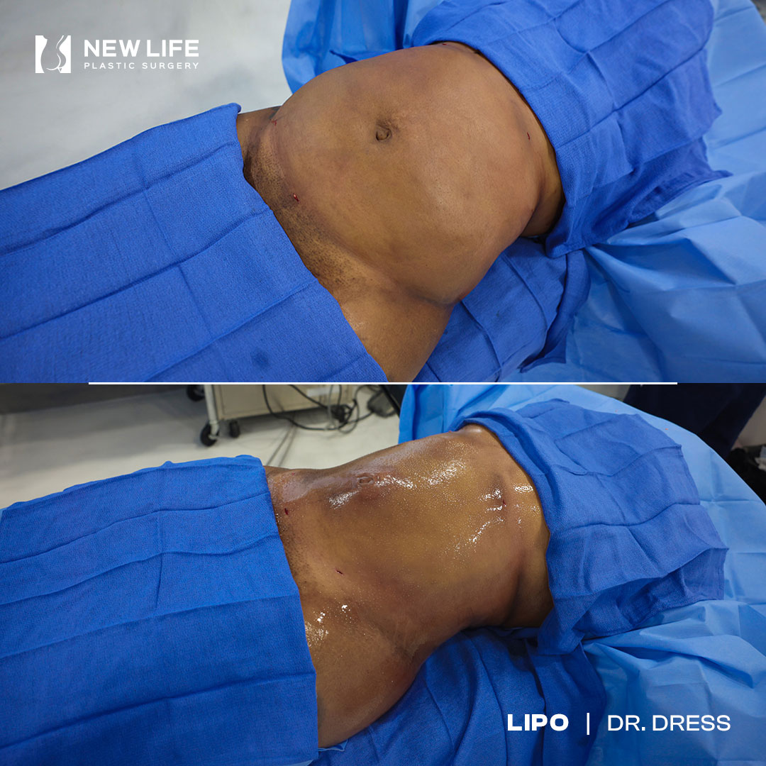 Liposuction before and after - before