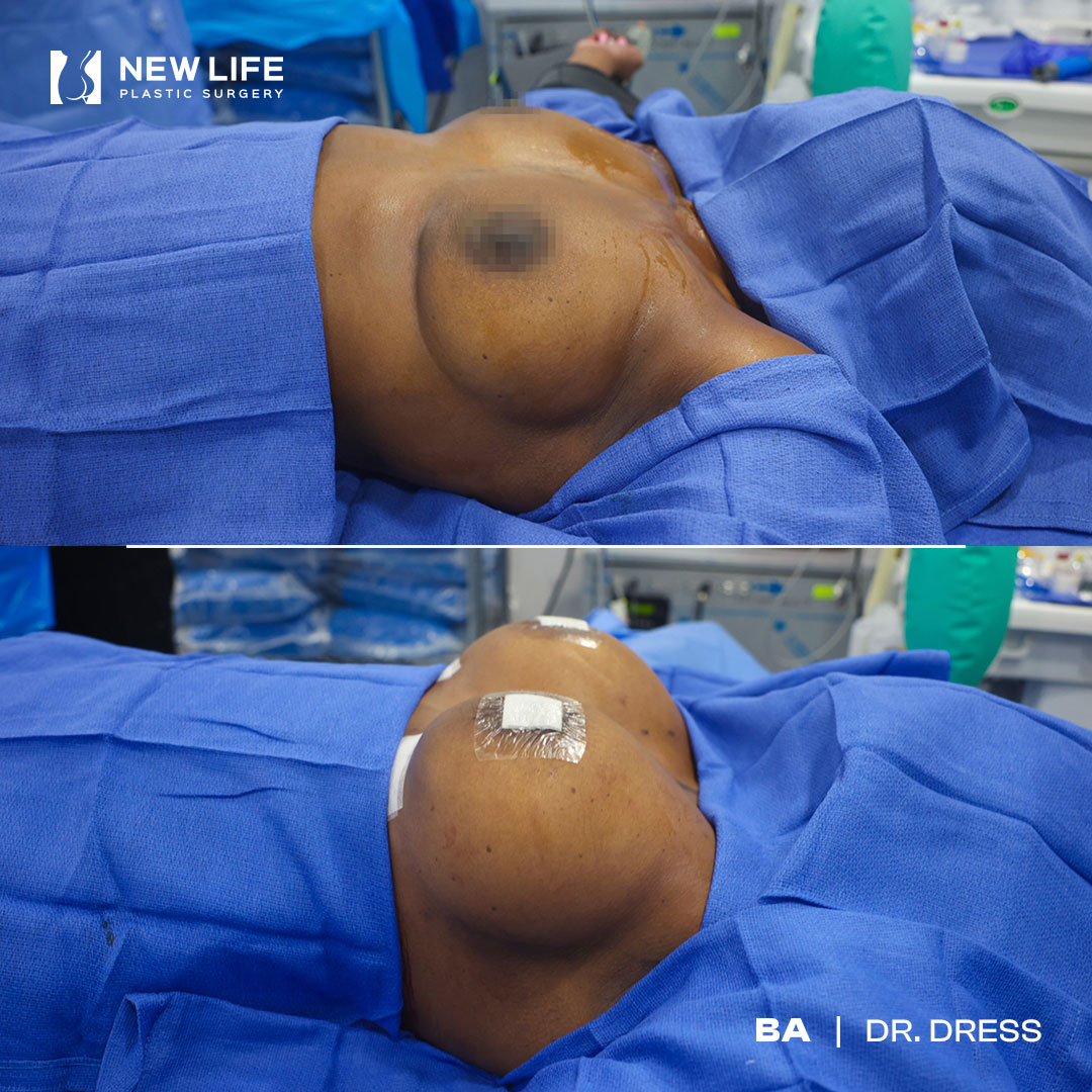 Breast Augmentation before and after - before
