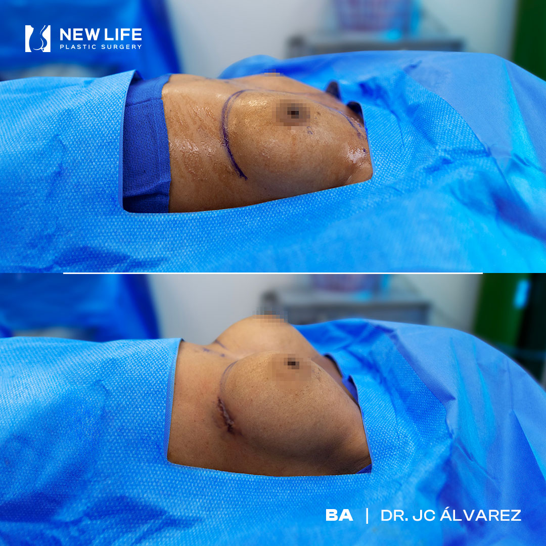 Breast Augmentation before and after - before