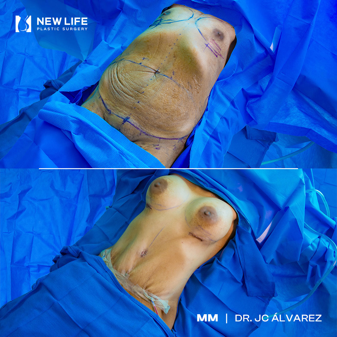 Mommy Makeover before and after - before