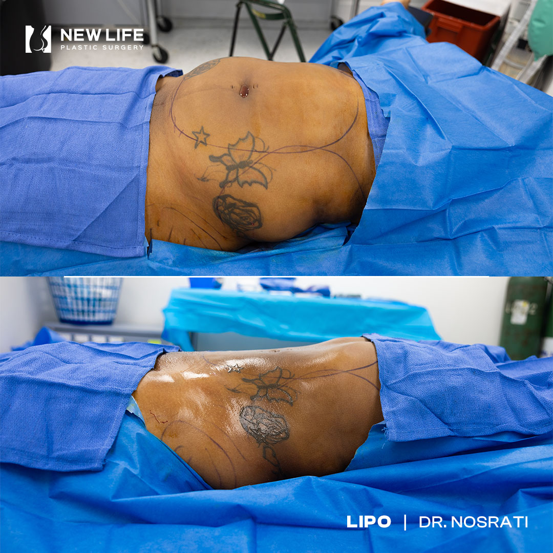 Liposuction before and after - before