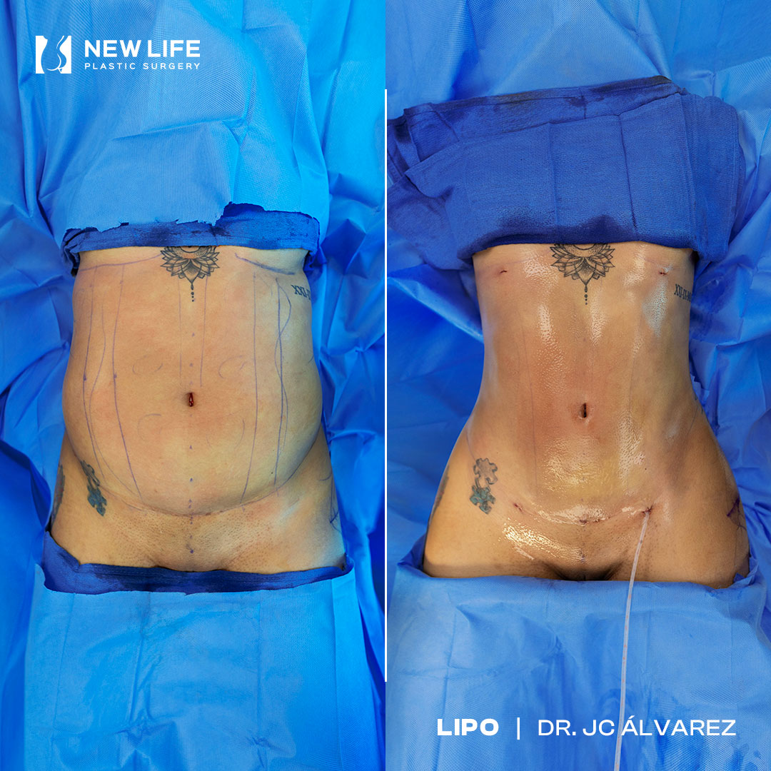 Liposuction before and after - before