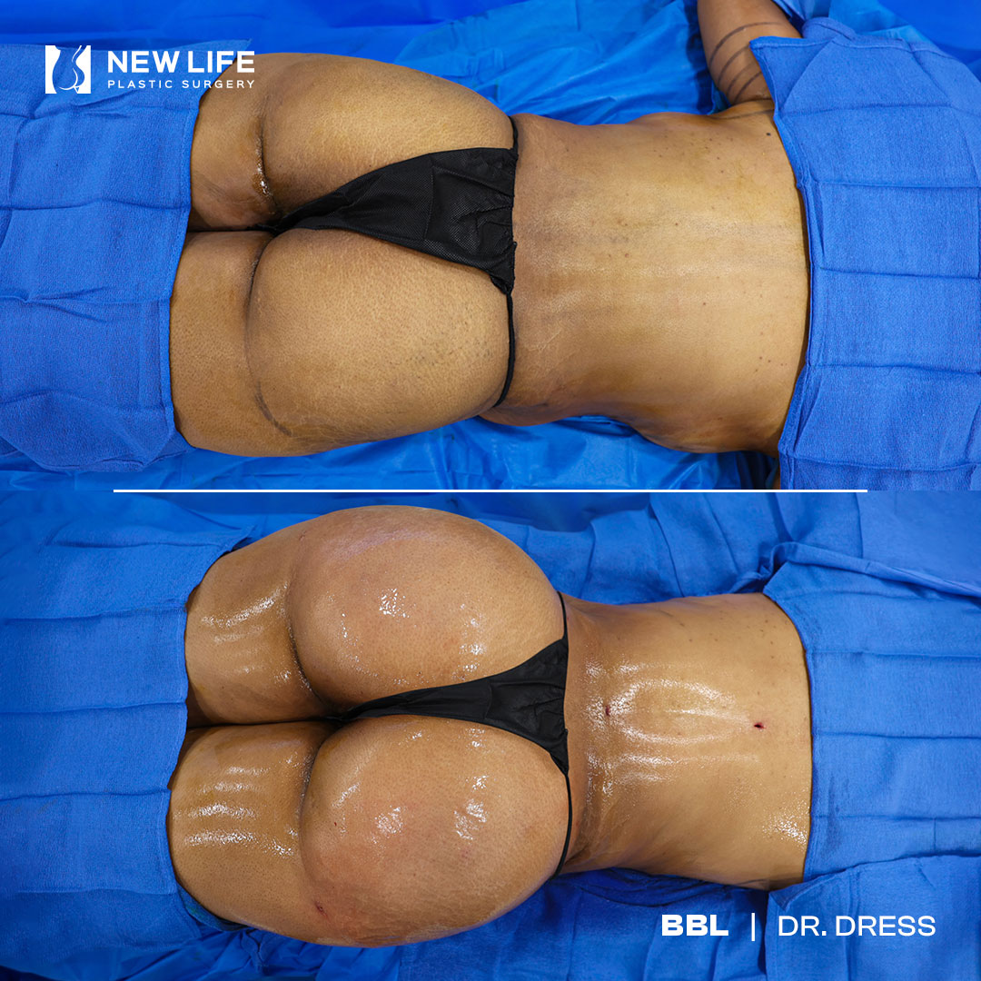 BBL before and after - before