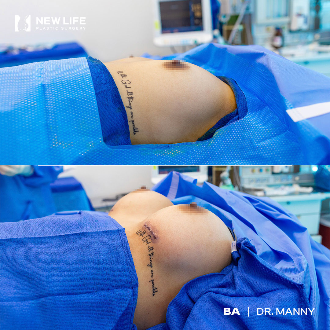 Breast Augmentation before and after - before