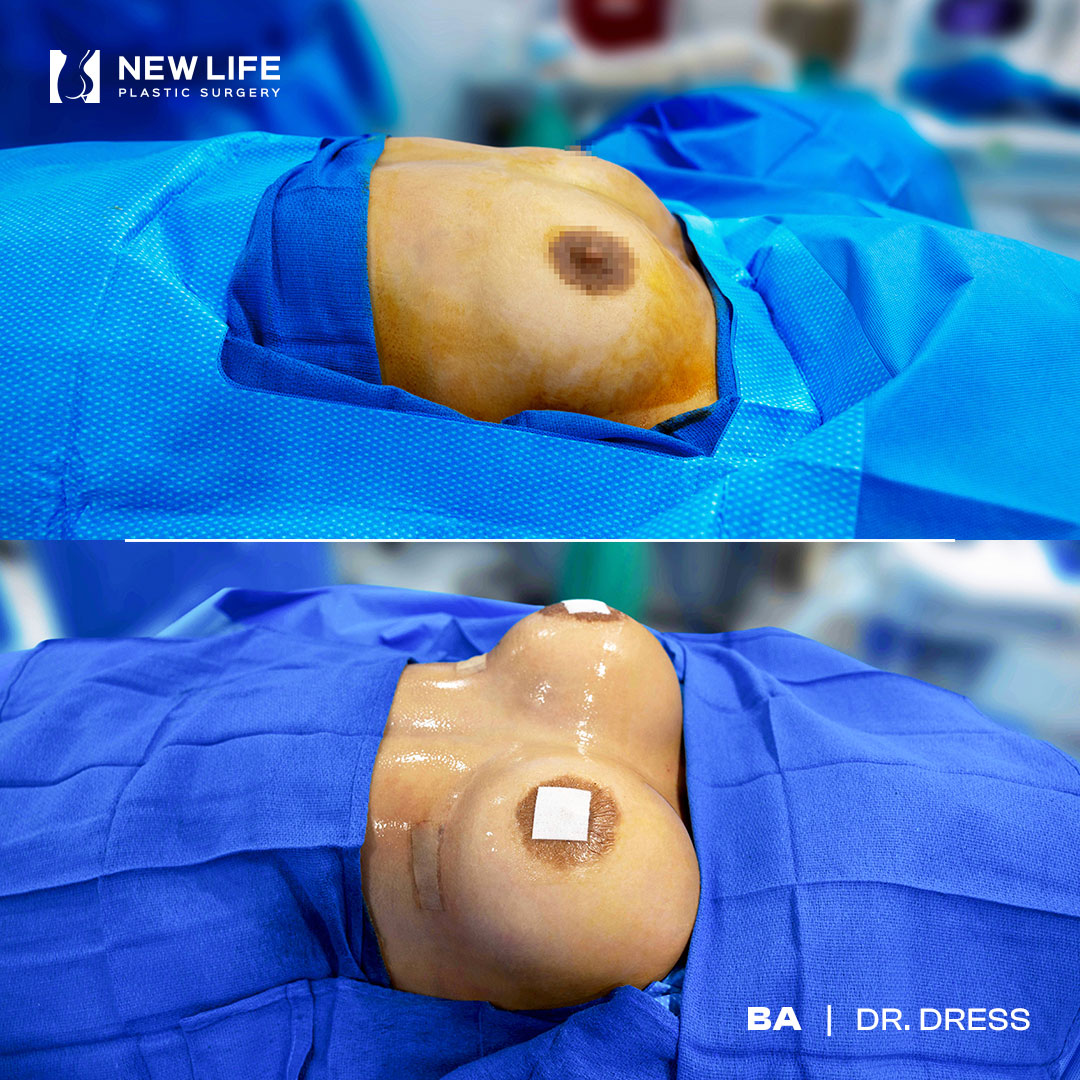 Breast Augmentation before and after - before