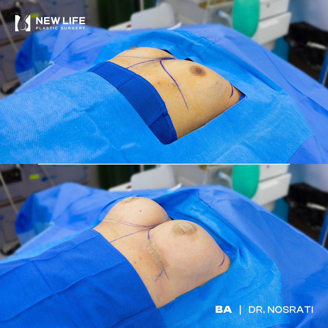 Breast Augmentation before and after - before