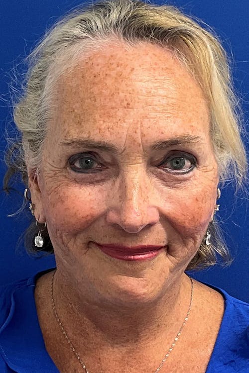 Facelift before and after - after
