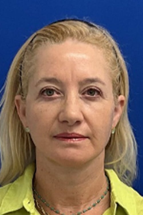 Facelift before and after - after
