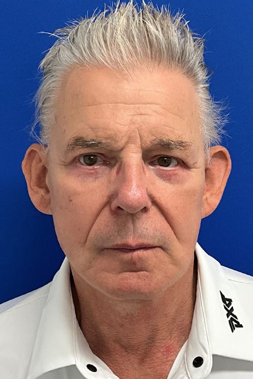 Facelift before and after - after
