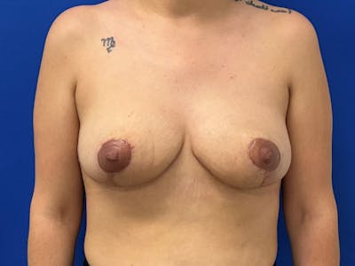 Breast Lift before and after - after
