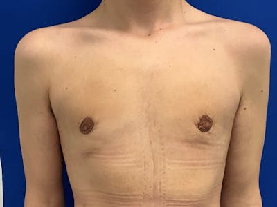Gynecomastia before and after - after