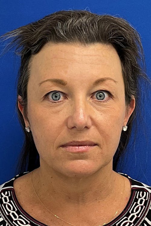 Facelift before and after - after