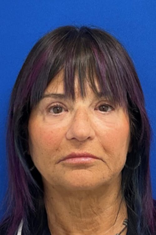 Blepharoplasty before and after - after