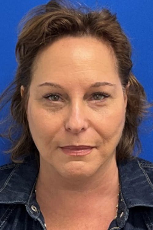 Blepharoplasty before and after - after