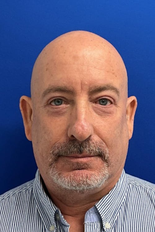 Blepharoplasty before and after - after