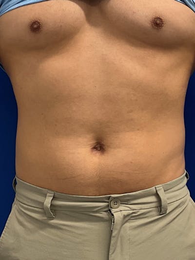 Procedure before and after - after