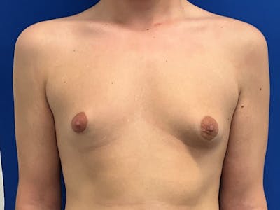 Gynecomastia before and after - before
