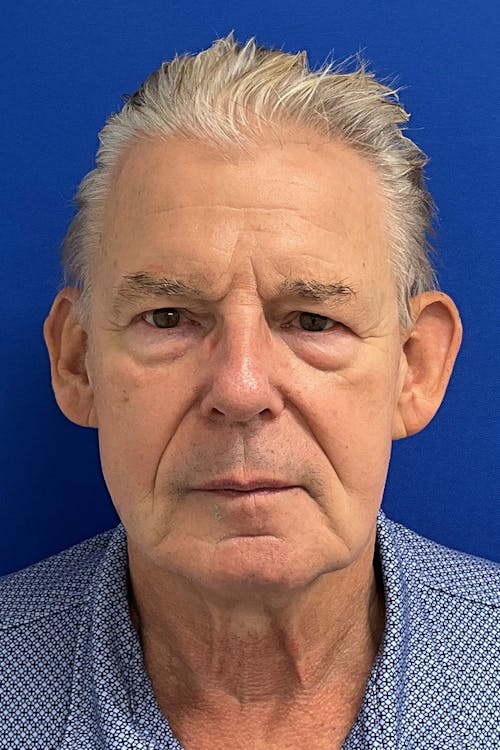 Facelift before and after - before