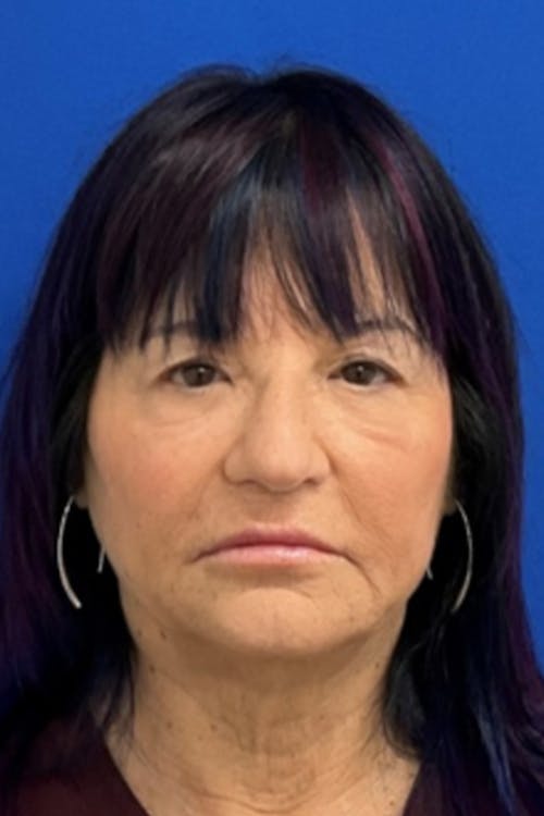 Blepharoplasty before and after - before
