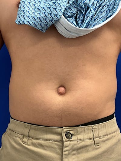Procedure before and after - before