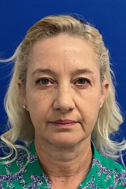 Facelift before and after - before