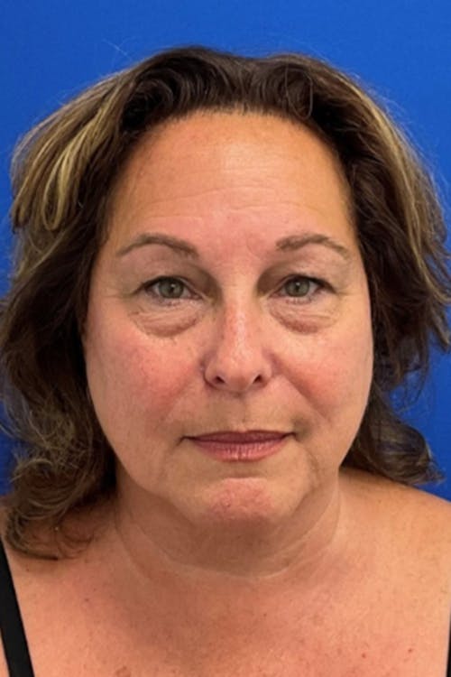 Blepharoplasty before and after - before