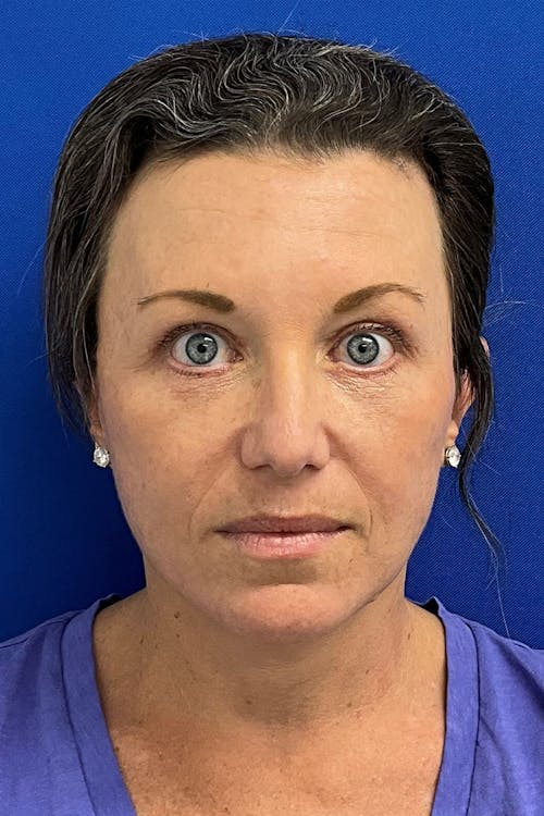 Facelift before and after - before