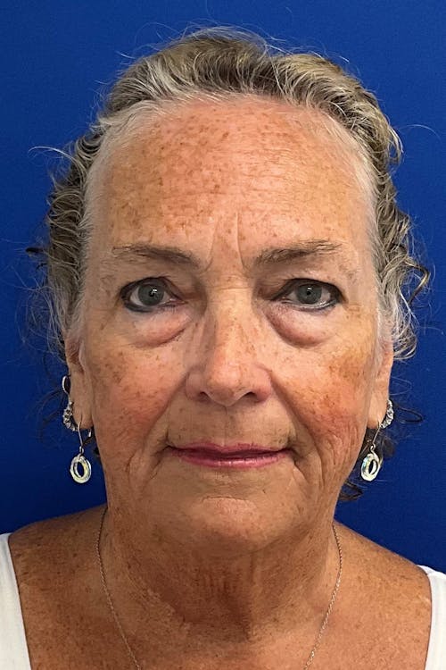 Facelift before and after - before