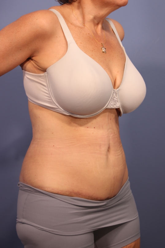 Tummy Tuck before and after - after