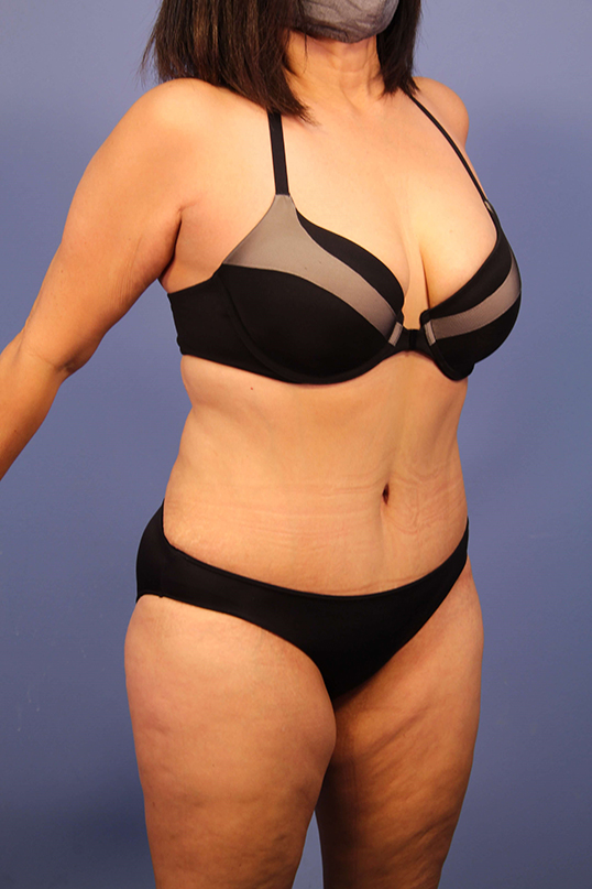 Tummy Tuck before and after - after
