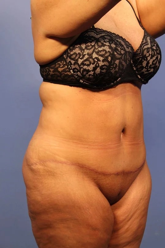Tummy Tuck before and after - after