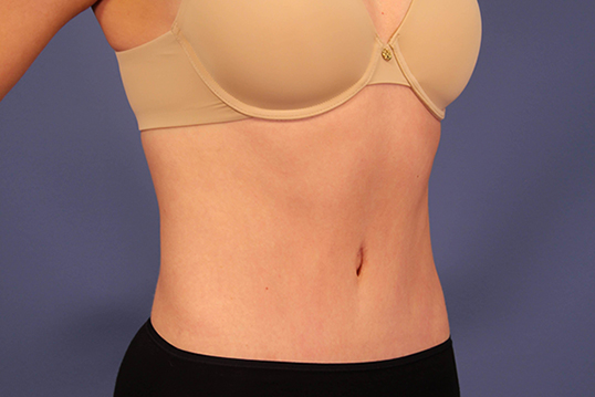 Tummy Tuck before and after - after