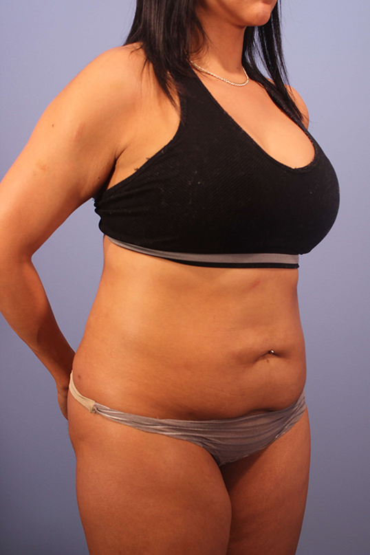 Tummy Tuck before and after - before