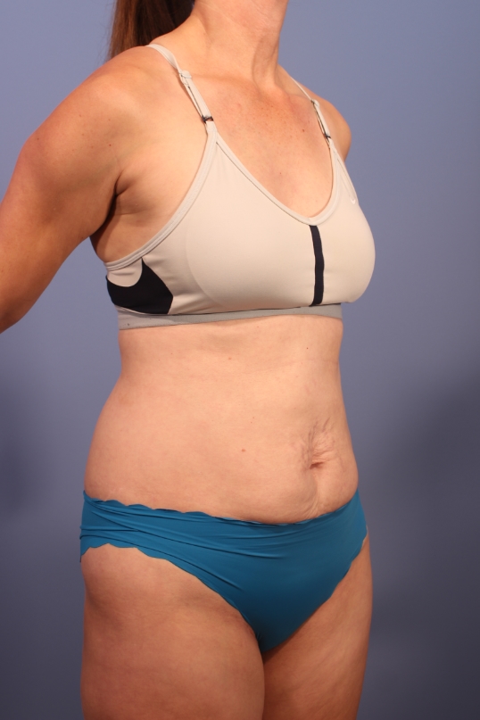 Tummy Tuck before and after - before